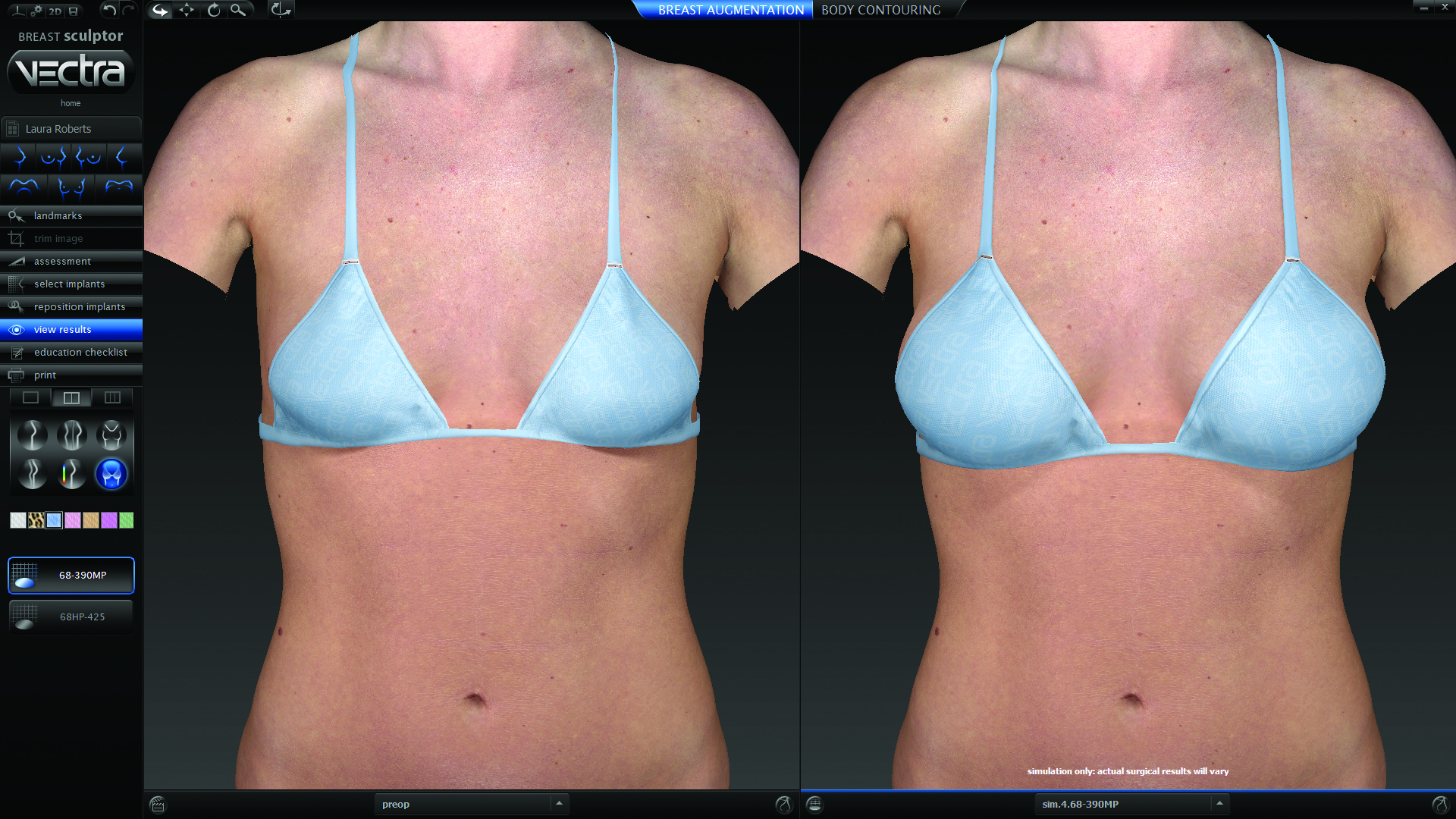 Crowder breast augmentation